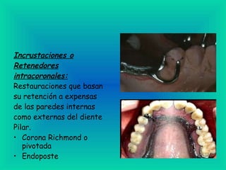 Incrustaciones o Retenedores intracoronales: Restauraciones que basan su retención a expensas de las paredes internas como externas del diente Pilar. Corona Richmond o pivotada  Endoposte  