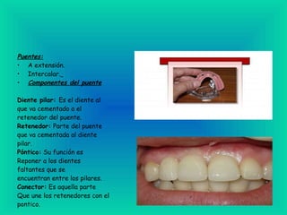 Puentes: A extensión.  Intercalar.   Componentes del puente Diente pilar:  Es el diente al que va cementado a el retenedor del puente.  Retenedor:  Parte del puente que va cementada al diente pilar.  Póntico:  Su función es Reponer a los dientes faltantes que se encuentran entre los pilares.  Conector:  Es aquella parte Que une los retenedores con el  pontico. 