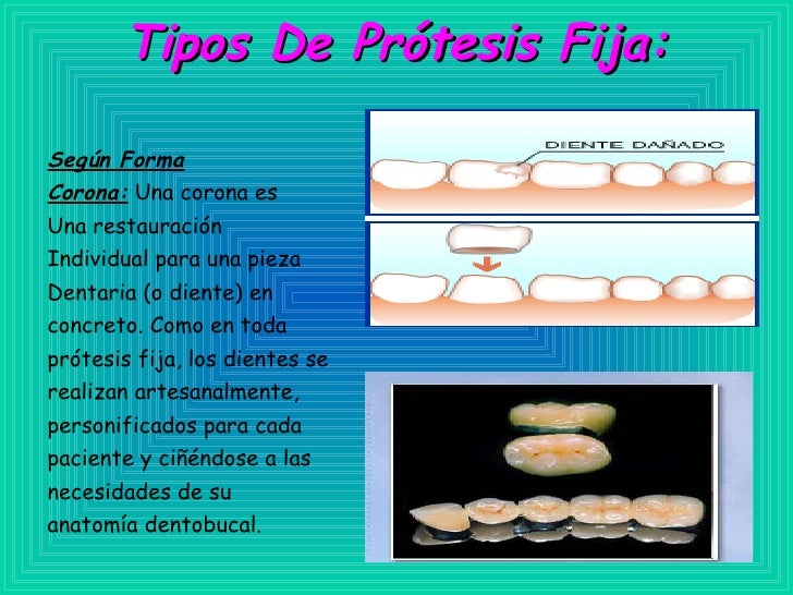Protesis Fijas Protesis Fijas