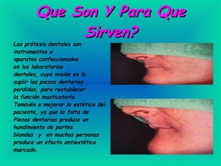 Que Son Y Para Que Sirven? Las prótesis dentales son instrumentos o aparatos confeccionados en los laboratorios dentales, cuya misión es la  suplir las piezas dentarias perdidas, para restablecer la función masticatoria. También a mejorar la estética del paciente, ya que la falta de Piezas dentarias produce un  hundimiento de partes blandas  y  en muchas personas produce un efecto antiestético marcado.                                                                                 