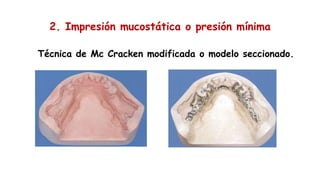 2. Impresión mucostática o presión mínima
Técnica de Mc Cracken modificada o modelo seccionado.
 