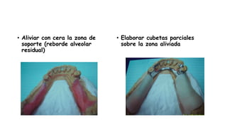 • Aliviar con cera la zona de
soporte (reborde alveolar
residual)
• Elaborar cubetas parciales
sobre la zona aliviada
 