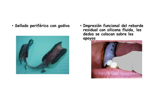 • Sellado periférico con godiva • Impresión funcional del reborde
residual con silicona fluida, los
dedos se colocan sobre los
apoyos
 