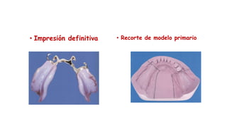 • Impresión definitiva • Recorte de modelo primario
 