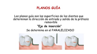 PLANOS GUÍA
Los planos guía son las superficies de los dientes que
determinan la dirección de entrada y salida de la prótesis
removible
“Eje de inserción”
Se determina en el PARALELIZADO
 