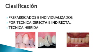  PREFABRICADOS E INDIVIDUALIZADOS
 POR TECNICA DIRECTA E INDIRECTA.
 TECNICA HIBRIDA
Clasificación
 