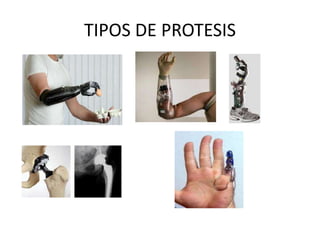TIPOS DE PROTESIS
 