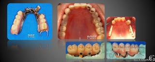 Protesis sobre implantes