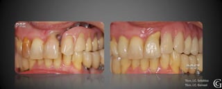 Protesis sobre implantes