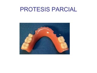 PROTESIS PARCIAL 