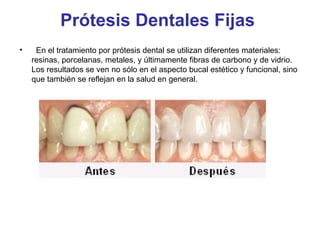 Prótesis Dentales Fijas      En el tratamiento por prótesis dental se utilizan diferentes materiales: resinas, porcelanas, metales, y últimamente fibras de carbono y de vidrio. Los resultados se ven no sólo en el aspecto bucal estético y funcional, sino que también se reflejan en la salud en general.  