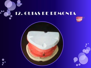 pasos para realizar una protesis total 