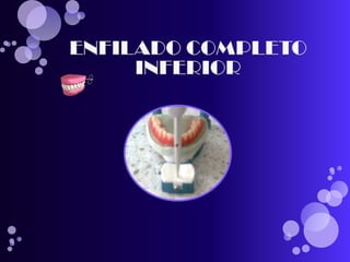 pasos para realizar una protesis total 