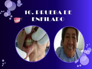 pasos para realizar una protesis total 