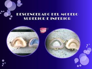 pasos para realizar una protesis total 