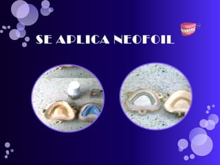 pasos para realizar una protesis total 