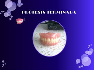 pasos para realizar una protesis total 