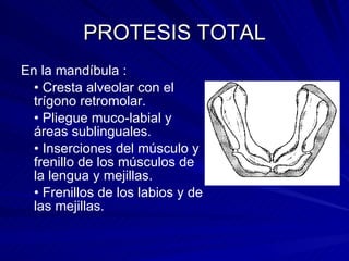 PROTESIS TOTAL En la mandíbula : •  Cresta alveolar con el trígono retromolar. •  Pliegue muco-labial y áreas sublinguales. •  Inserciones del músculo y frenillo de los músculos de la lengua y mejillas. •  Frenillos de los labios y de las mejillas. 