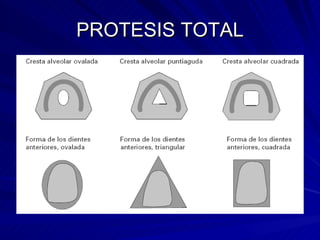 PROTESIS TOTAL 