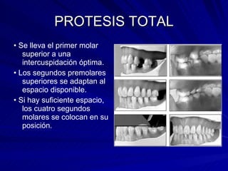 PROTESIS TOTAL •  Se lleva el primer molar superior a una intercuspidación óptima. •  Los segundos premolares superiores se adaptan al espacio disponible. •  Si hay suficiente espacio, los cuatro segundos molares se colocan en su posición. 
