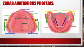 ZONAS ANATÓMICAS PROTESIS:
 