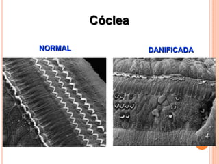 Cóclea
NORMAL DANIFICADA
 