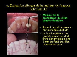 a. Evaluation clinique de la hauteur de l’espace
rétro-incisif
• Mesure de la
profondeur du sillon
gingivo-dentaire
• Report de cette mesure
sur le modèle d’étude
• Le bord supérieur du
grand connecteur doit
être distant d’au moins
2 mm du fond du sillon
gingivo-dentaire.
 