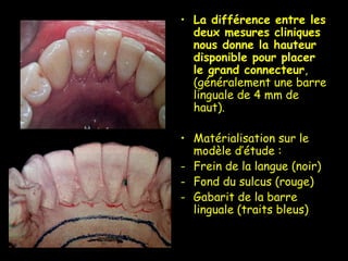• La différence entre les
deux mesures cliniques
nous donne la hauteur
disponible pour placer
le grand connecteur,
(généralement une barre
linguale de 4 mm de
haut).
• Matérialisation sur le
modèle d’étude :
- Frein de la langue (noir)
- Fond du sulcus (rouge)
- Gabarit de la barre
linguale (traits bleus)
 