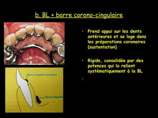 b. BL + barre corono-cingulaire
• Prend appui sur les dents
antérieures et se loge dans
les préparations coronaires
(sustentation)
• Rigide, consolidée par des
potences qui la relient
systématiquement à la BL
.
 