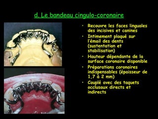 d. Le bandeau cingulo-coronaire
• Recouvre les faces linguales
des incisives et canines
• Intimement plaqué sur
l’émail des dents
(sustentation et
stabilisation)
• Hauteur dépendante de la
surface coronaire disponible
• Préparations coronaires
indispensables (épaisseur de
1,7 à 2 mm)
• Couplé avec des taquets
occlusaux directs et
indirects
 