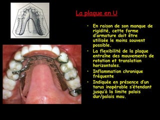 La plaque en U
• En raison de son manque de
rigidité, cette forme
d’armature doit être
utilisée le moins souvent
possible.
• La flexibilité de la plaque
entraîne des mouvements de
rotation et translation
horizontales.
• Inflammation chronique
fréquente
• Indiquée en présence d’un
torus inopérable s’étendant
jusqu’à la limite palais
dur/palais mou.
 