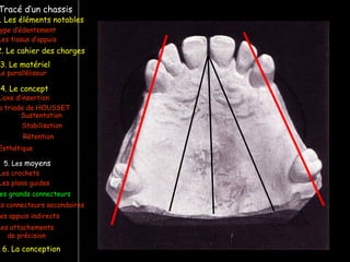 Tracé d’un chassis
ype d’édentement
Les crochets
L’axe d’insertion
Les plans guides
a triade de HOUSSET
Les tissus d’appuis
Sustentation
Stabilisation
Rétention
Esthétique
es grands connecteurs
es connecteurs secondaires
Le paralléliseur
. Les éléments notables
3. Le matériel
4. Le concept
5. Les moyens
Les appuis indirects
6. La conception
2. Le cahier des charges
Les attachements
de précision
 