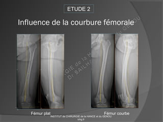 Influence de la courbure fémorale
Fémur plat Fémur courbe
ETUDE 2
INSTITUT de CHIRURGIE de la HANCE et du GENOU
ichg.fr
 