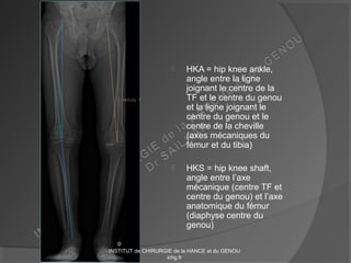  HKA = hip knee ankle,
angle entre la ligne
joignant le centre de la
TF et le centre du genou
et la ligne joignant le
centre du genou et le
centre de la cheville
(axes mécaniques du
fémur et du tibia)
 HKS = hip knee shaft,
angle entre l’axe
mécanique (centre TF et
centre du genou) et l’axe
anatomique du fémur
(diaphyse centre du
genou)
INSTITUT de CHIRURGIE de la HANCE et du GENOU
ichg.fr
 