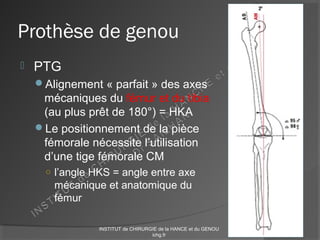Prothèse de genou
 PTG
Alignement « parfait » des axes
mécaniques du fémur et du tibia
(au plus prêt de 180°) = HKA
Le positionnement de la pièce
fémorale nécessite l’utilisation
d’une tige fémorale CM
○ l’angle HKS = angle entre axe
mécanique et anatomique du
fémur
INSTITUT de CHIRURGIE de la HANCE et du GENOU
ichg.fr
 