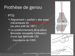 Prothèse de genou
 PTG
Alignement « parfait » des axes
mécaniques du fémur et du tibia
(au plus prêt de 180°)
Le positionnement de la pièce
fémorale nécessite l’utilisation
d’une tige fémorale CM
○ Importance de l’HKS
INSTITUT de CHIRURGIE de la HANCE et du GENOU
ichg.fr
 