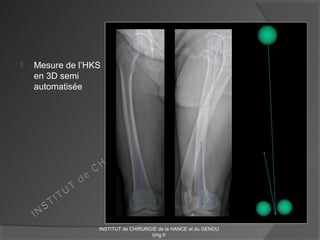  Mesure de l’HKS
en 3D semi
automatisée
INSTITUT de CHIRURGIE de la HANCE et du GENOU
ichg.fr
 