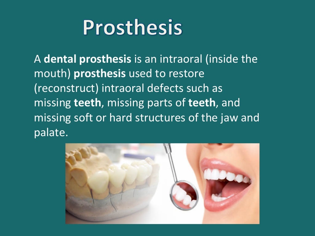 Different types of dental prosthesis