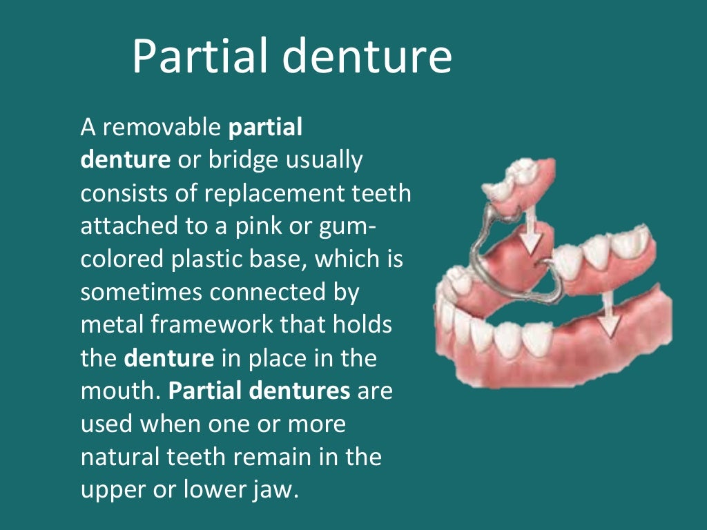 Different types of dental prosthesis