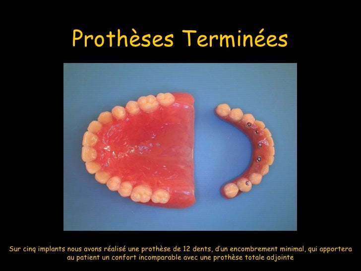 Prothèse Amovible Définitive à Châssis Métallique Comportant 6 Dents