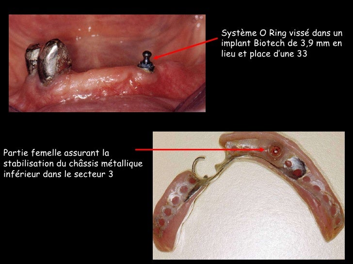 Qu Est Ce Qu Une Infrastructure Coronaire Sur Implant