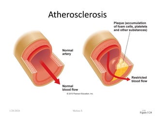 Atherosclerosis
Figure 5.24
1/28/2024 198
Melese.S
 