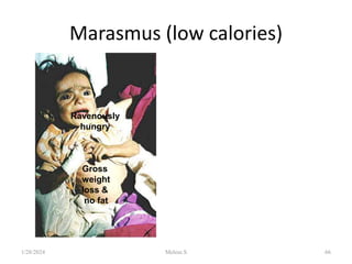 Marasmus (low calories)
Ravenously
hungry
Gross
weight
loss &
no fat
1/28/2024 Melese.S 66
 