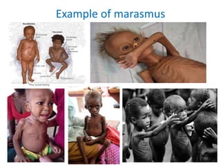 Example of marasmus
1/28/2024 Melese.S 70
 