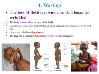 • The loss of flesh is obvious. so skin becomes
wrinkled
• The belly is contrast to the rest of the body
• Looks highly emaciated with all skin & bone appearance sunken eyes, prominent
ribs.
• Hence it is called wasting disease.
• The face has a characteristics simian (monkey like) appearance.
1. Wasting
1/28/2024 Melese.S 71
 