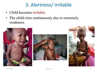 • Child becomes irritable.
• The child cries continuously due to extremely
weakness.
3. Alertness/ irritable
1/28/2024 Melese.S 73
 