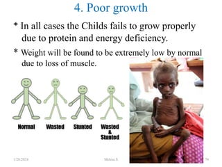 * In all cases the Childs fails to grow properly
due to protein and energy deficiency.
* Weight will be found to be extremely low by normal
due to loss of muscle.
4. Poor growth
1/28/2024 Melese.S 74
 