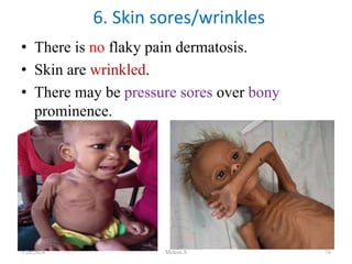 • There is no flaky pain dermatosis.
• Skin are wrinkled.
• There may be pressure sores over bony
prominence.
6. Skin sores/wrinkles
1/28/2024 Melese.S 76
 