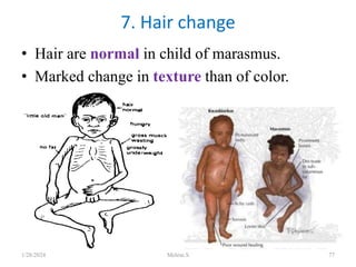 • Hair are normal in child of marasmus.
• Marked change in texture than of color.
7. Hair change
1/28/2024 Melese.S 77
 
