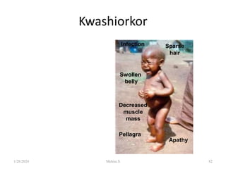 Kwashiorkor
Swollen
belly
Pellagra
Decreased
muscle
mass
Sparse
hair
Infection
Apathy
1/28/2024 Melese.S 82
 